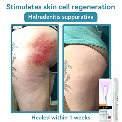 💕 All-in-One CO₂ Laser Eraser Pen | Removes Moles, Warts, Skin Flaws & Pigmentation✅